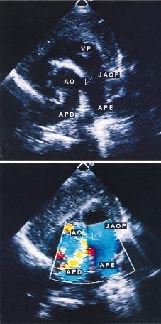 Constatou-se queda abrupta da pressão da artéria pulmonar durante a cirurgia, logo após o fechamento da comunicação, nas JAoP isoladas.