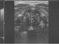 Figura 1 Prega vocal com mobilidade normal ao US com Doppler. Figure 4A Nasofibroscopio passando através da cânula de Guedel. Figura 2 Paresia de prega vocal esquerda ao US com Doppler.