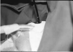 O aparelho de endoscopia era introduzido pela cânula de Guedel e posicionado na região posterior da laringe, o nervo laríngeo recorrente era estimulado, então, com a intensidade de corrente de meio