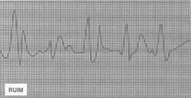 Um eletrocardiograma éapenasum registro gráfico das correntes elétricas produzidas pela atividade do músculo cardíaco (coração) com respeito ao tempo. Figura 22.10: Eletrocardiograma: pessoa saudável.