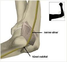 Síndrome do Canal Cubital (Túnel) Compressão do nervo ulnar na