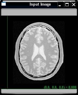 Segmentação Segmentação de objetos em imagens médicas: método de level set Imagem original Segmentação