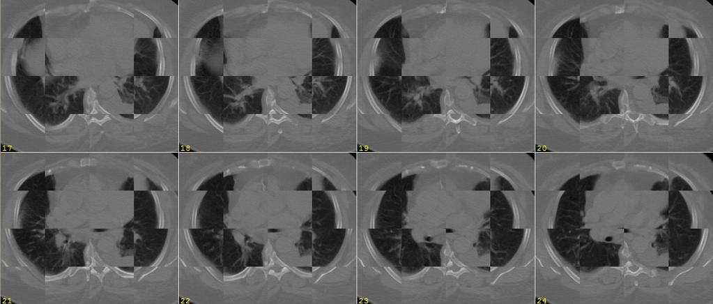 Alinhamento Alinhamento de imagens 3D: otimização iterativa, alinhamento 3D cont. Xadrez das imagens pré-alinhamento (CT, tórax mesma pessoa, Δt: 8.