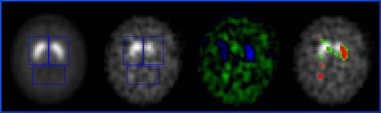 Alinhamento Aplicação no estudo de imagens DaTSCAN SPECT Slice médio de uma população usada como referência Slice correspondente de um paciente Diferença de intensidades Mapeamento dos Z- scores no