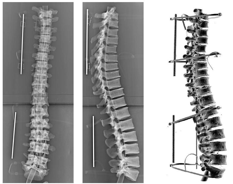 Visão 3D Reconstrução 3D a partir de radiografias 2D: calibração Estimativa da distância entre a fonte de Raio-X e a mesa Duas radiografias de uma coluna seca usada para validar a