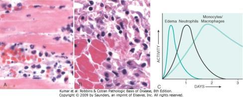 Resposta Inflamatória Crônica Inflamação aguda x crônica Características Respostas a microorganismos intracelulares