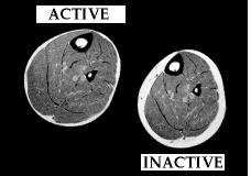 Efeitos da Inatividade Atrofia muscular (diminuição no tamanho