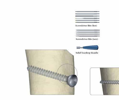 Técnica cirúrgica Técnica cirúrgica Conjunto de extracção de implantes Conjunto de extracção de implantes Parafusos Após a identificação do tipo e diâmetro do parafuso, extraia os parafusos com a