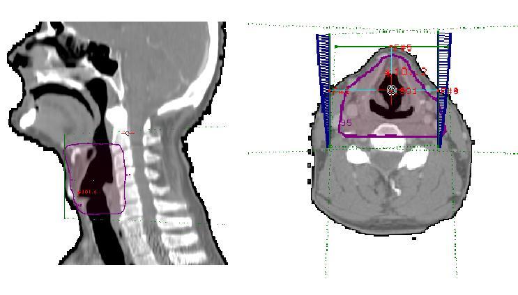 13 Figura 2: Planejamento 3D visualizado nos planos sagital e axial. Fonte: Elaborada pela autora.