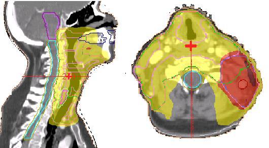 14 Figura 3: Radioterapia de Intensidade Modulada visualizada nos planos sagital e axial. Fonte: Elaborada pela autora.