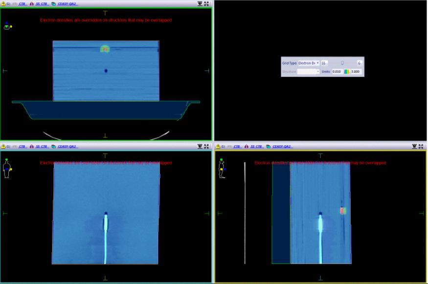 45 Para fins de planejamento, a densidade eletrônica das áreas de artefato e do implante de titânio foram forçadas no sistema, através de atribuição manual de novos valores de densidade eletrônica