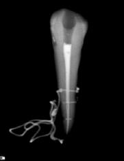 O meio de avaliação no presente estudo foi a radiografia digital. Esta foi escolhida por apresentar maior rapidez, fidelidade da imagem, segurança e facilidade de comunicação.