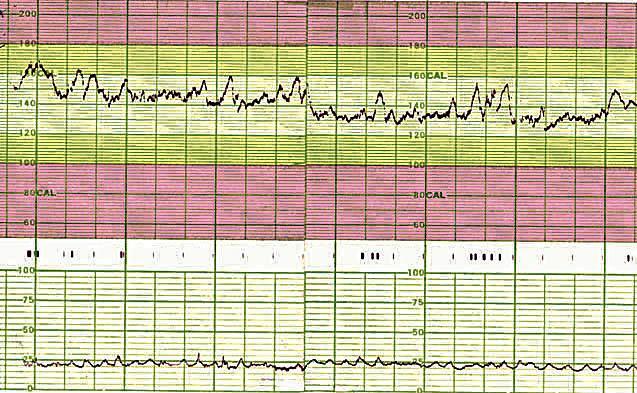 A) os ascensos da freqüência cardíaca fetal relacionam-se à integridade do sistema nervoso central. B) diante desse traçado, a gestação deve ser interrompida.