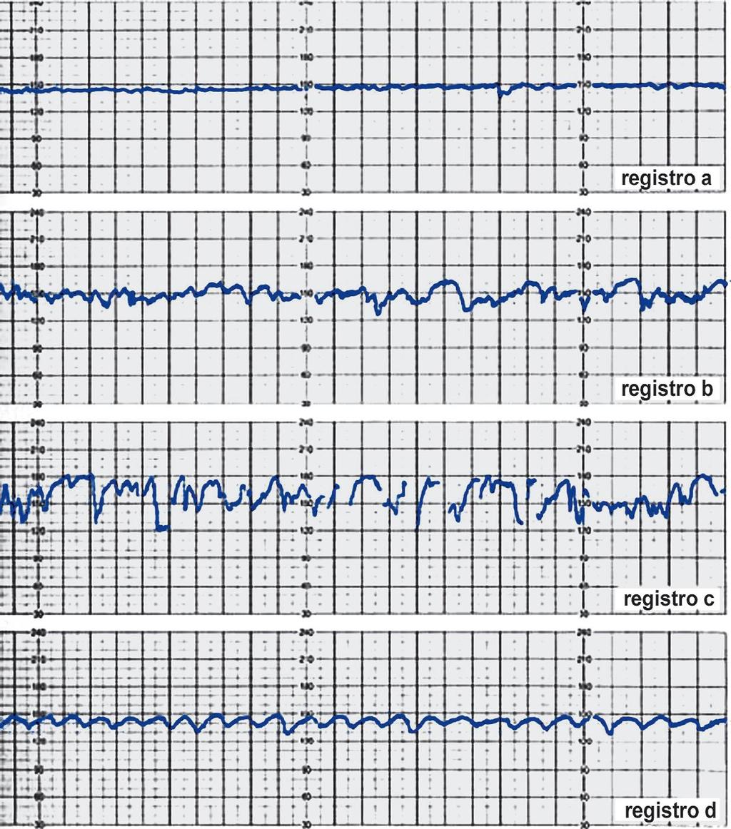 15- Dos registros apresentados, obtidos durante o trabalho de parto, o que mostra padrão sinusoidal da freqüência cardíaca é o: A) registro a. B) registro b. C) registro c. D) registro d.