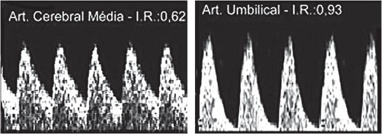 17- A hipóxia do sistema nervoso central fetal altera os parâmetros biofísicos na sequência seguinte: A) cardiotocografia, movimentos respiratórios fetais, movimentos fetais e tônus