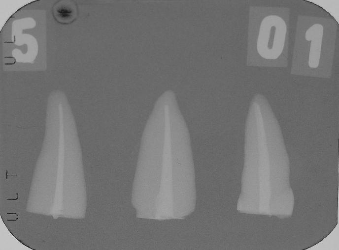 A B Figura 1 - Tomada radiográfica para verificação da qualidade da endodontia. A) norma mesio-distal e B) norma vestíbulo-palatina FONTE: Dados da pesquisa.