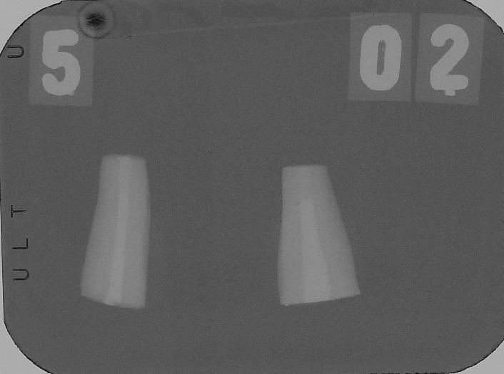A B Figura 12 - Tomada radiográfica para verificação da qualidade das retrobturações: A) dentes nº 8 do grupo 01 (amálgama, Vitremer e MTA, respectivamente); B) dentes nº 5 do grupo 02 (CPB e Fuji