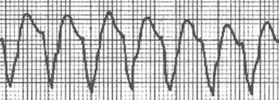 ventricular) X Taquicardia