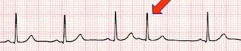 ventricular   ventricular)