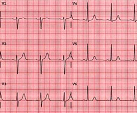 Complexo QRS Amplitude