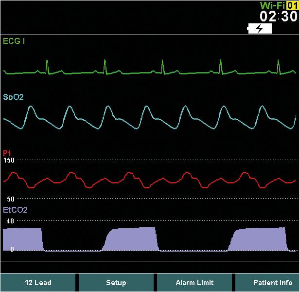 OPÇÕES ECG DE 12 CANAIS Todas as 12 derivações de ECG representáveis