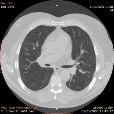 C. Classificação A classificação tem como objetivo a rotulação de candidatos a nódulos pulmonares a partir de dados já rotulados, tendo como vetor de entrada as características extraídas das imagens