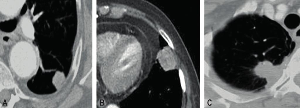 20,21 (Q): Qual T deve ser atribuído a um carcinoma pulmonar de qualquer tamanho, que se estende superficialmente, com o seu componente invasivo limitado à parede brônquica (Figura 4), se ele