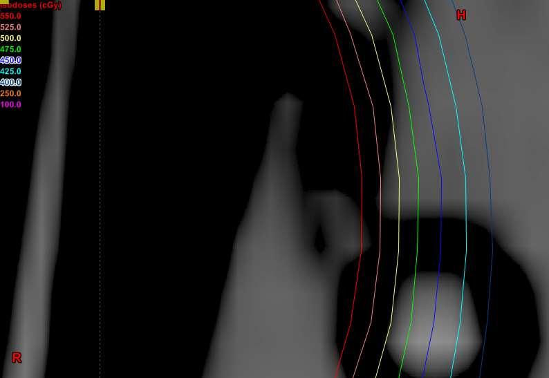 Curvas de isodose no volume da cápsula Cápsula de TLD Figura 4.6 Alto gradiente de dose na cápsula de TLD em um dos planejamentos realizados no sistema de planejamento brachyvision.