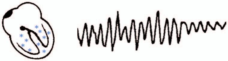 11 Figura 01 Ritmos cardíacos na parada cardíaca Ritmo sinusal Ativação elétrica fisiológica Integridade dos mecanismos de acoplamento excitação-contração Débito cardíaco sistêmico normal Fibrilação