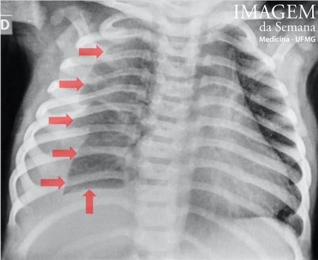 Análise da imagem Imagem 1: Radiografia de tórax,