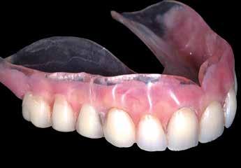 Bending strength of intact and repaired denture base resins. Acta Odontol Scand. 1983; 41(3):187-91. 2. Beyli MS, Von Fraunhofer JA. An analysis of causes of fracture of acrylic resin dentures.