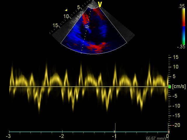 cm/s. Onda e septal Doppler tissular =