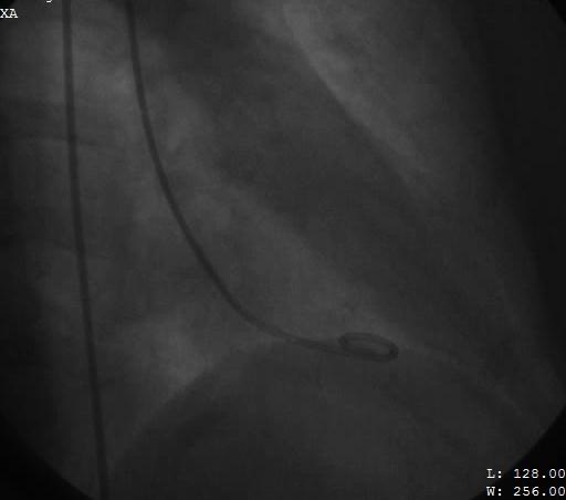 Picci A et al. World J Cardiol.