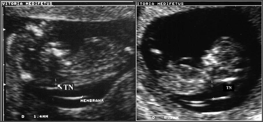 França LC, Murta CGV Figura 1. Fetos de 12 semanas apresentando medidas da translucência nucal de 1,4 mm e 6,1 mm. lias cromossômicas.