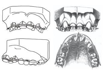 Revisão de Literatura 29 Este aparelho, em que os fios eram de bronze, resultava em baixa eficiência nas estabilizações dos dentes no pós-tratamento.