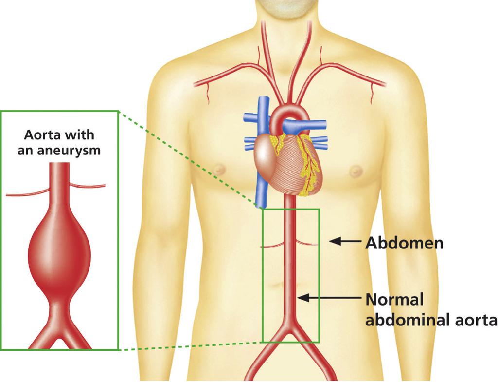 O resultado do seu rastreio Constatámos que uma secção da sua aorta é um pouco maior do que o normal. Isto significa que tem um aneurisma da aorta abdominal (AAA) de pequena dimensão.