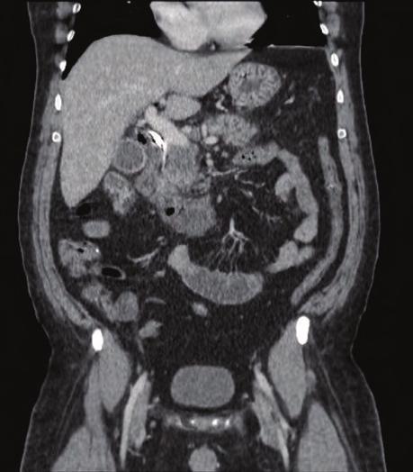 Foi realizada nova TC de abdome com contraste oral e endovenoso para controle no sétimo dia de tratamento clínico (figuras 6 e 7), sendo programada a gastroduodenopancreatectomia, depois de forma