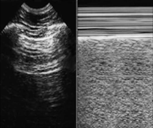 Imagem 3: Ultrassonografia normal - Linhas A e sinal da praia.