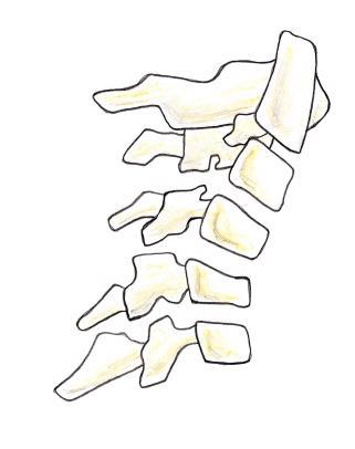 5) Resulta de uma lesão de flexão pura da CC, em que uma força longitudinal é exercida sobre o ligamento nucal, que geralmente fica intacto.