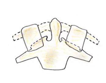 Esta fratura ocorre quando o LLA desloca o fragmento para fora do aspeto inferior do corpo vertebral devido a uma hiperextensão súbita.