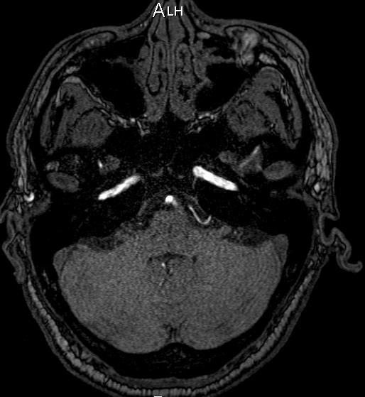 AngioRM arterial Ausência de sinal em todo o
