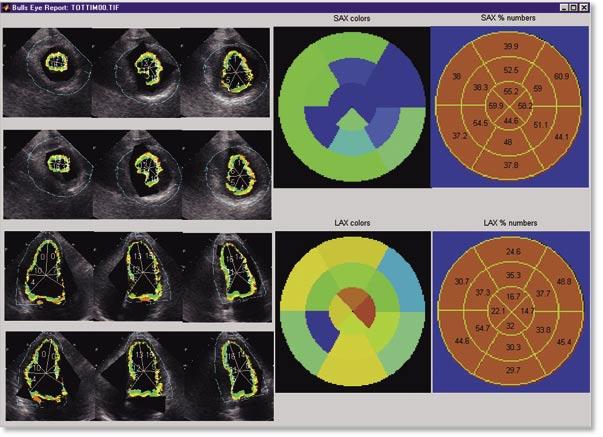 A cavidade ventricular é, então, dividida em quatro (no corte apical), ou em seis (nos segmentos médio e basal) segmentos angulares iguais.