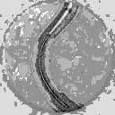 Uma evolução: o stent (tela de aço inoxidável) acompanha o balão e consegue aumentar a eficácia do procedimento.