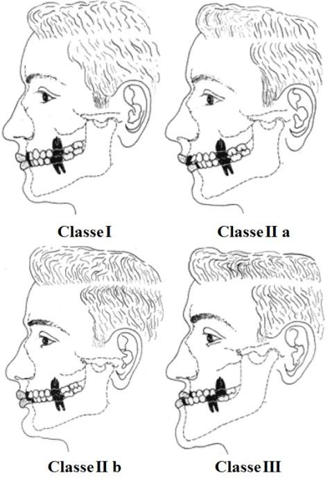 64 distolingual do primeiro molar superior oclui a área central da fossa do primeiro molar inferior.