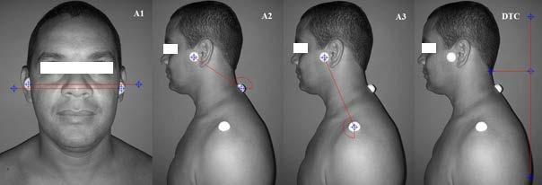 68 torácico e o ponto do ápice da concavidade cervical. Com o ângulo 1 (A1), foi possível verificar a inclinação/rotação da cabeça no plano frontal, sendo o ângulo positivo no sentido anti-horário.