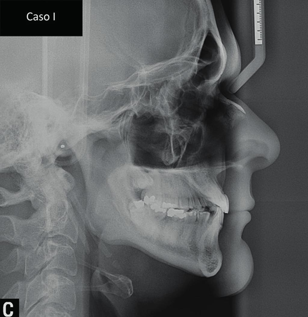 Tele Radiografia em norma lateral: notar projeções radiopacas (entre ângulo da mandíbula e a coluna cervical)