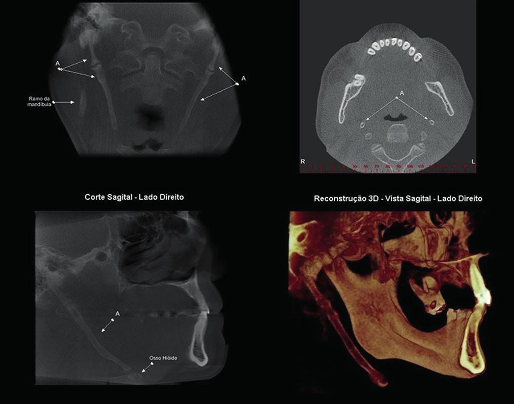 Caso II Cortes Tomográficos evidenciando projeção hiperdensa bilateral, de orientação oblíqua (corte coronal), em espaço carotídeo (corte axial), com direcionamento anterior inferior (corte sagital e