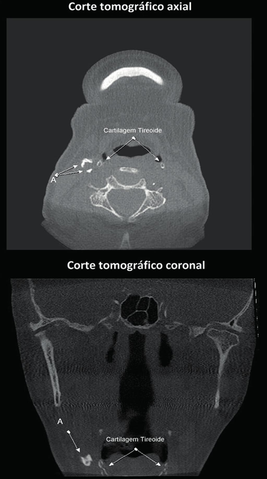 Os cortes tomográficos axial e coronal mostram imagem hiperdensa de aspecto tubular em espaço carotídeo, lado