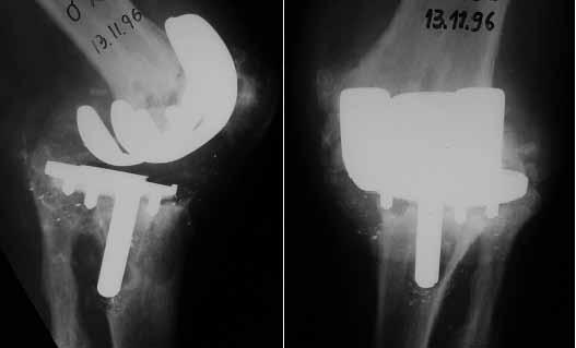 COMPONENTE TIBIAL NA REVISÃO DA ARTROPLASTIA DO JOELHO: COMPARAÇÃO ENTRE FIXAÇÃO CIMENTADA E HÍBRIDA 587 Os seguintes dados foram analisados nas radiografias pré-operatórias: a) Posição