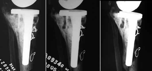 Observar a reação cortical posterior e migração da haste. Figura 1 (A) Soltura de artroplastia com perda óssea tibial AORI 3. (B) Pós-operatório imediato.